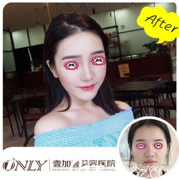 合肥壹加壹孟松隆鼻變化圖