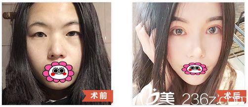 包頭華美醫(yī)療美容白虎雙眼皮前后對(duì)比圖