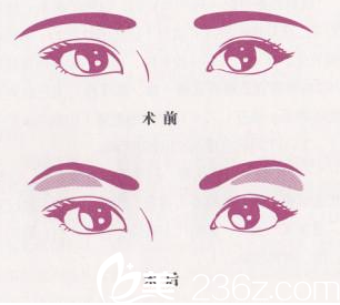 眉弓填充示意圖