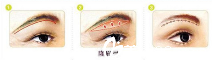 填充眉弓手術(shù)示意圖