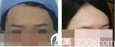 韓旭醫(yī)生填充眉弓案例一