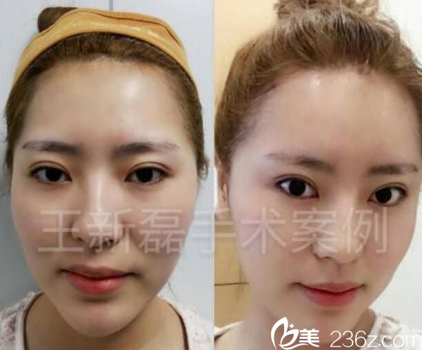 王新磊自體脂肪全臉填充案例前后效果對比圖 王新磊自體脂肪全臉填充案例前后效果對比圖