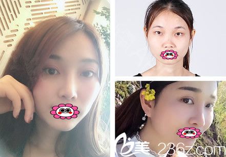 嘉興曙光雙眼皮前后對比案例