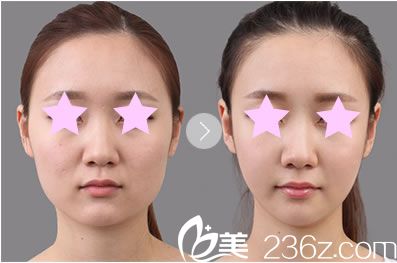 桂林華美整形線雕V臉提升前后對比圖