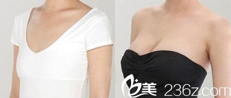 華美連鎖整形隆胸前后對比照片