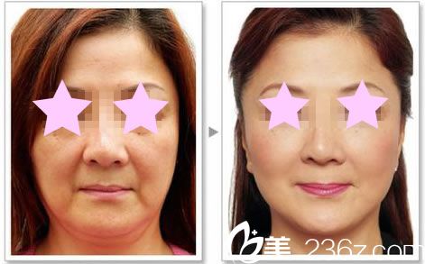 華美整形全臉線雕提升效果