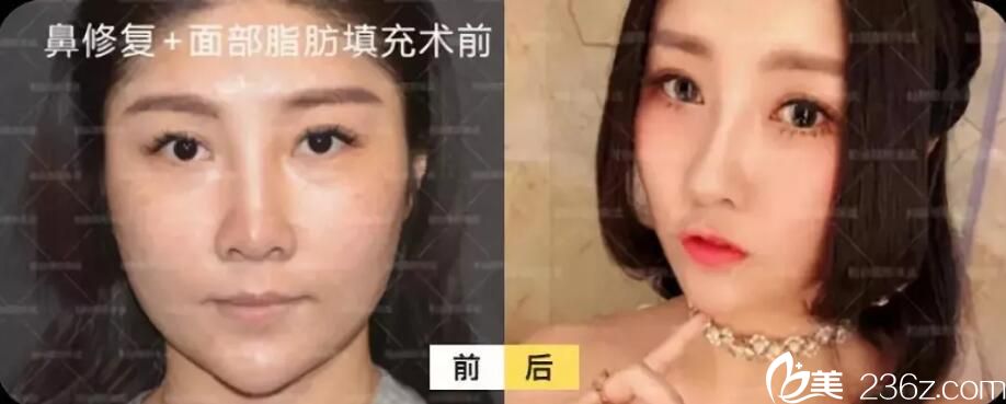 張武隆鼻失敗修復(fù)+自體脂肪全臉填充案例前后效果對(duì)比圖
