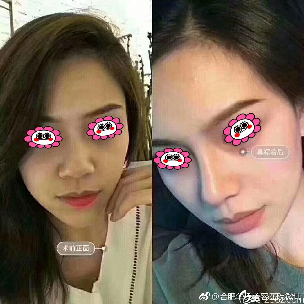 華美整形楊鵬隆鼻前后對比圖