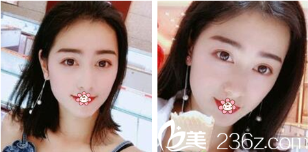 韓國(guó)夏娃eve整形外科做雙眼皮怎么樣