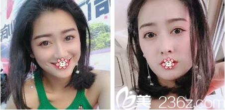 韓國(guó)夏娃eve整形鄭潤(rùn)載做雙眼皮效果怎么樣