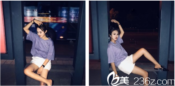 深圳美萊郭杰大腿吸脂20天效果圖