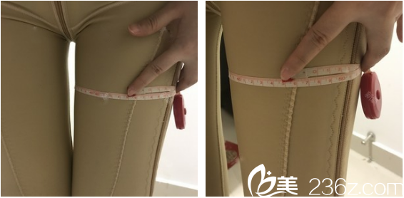 深圳美萊大腿吸脂7天測量效果