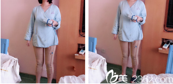 深圳美萊大腿吸脂三天自拍照片