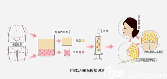 高學(xué)龍醫(yī)生講自體脂肪移植原理