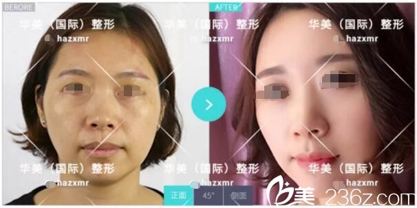 術(shù)前淚溝鼻唇溝明顯，太陽穴凹陷做脂肪填充改善