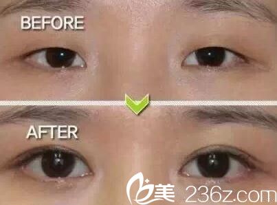 寒假熱門(mén)整形項(xiàng)目雙眼皮整形