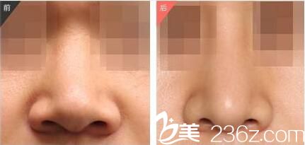 鼻整形前后效果對(duì)比