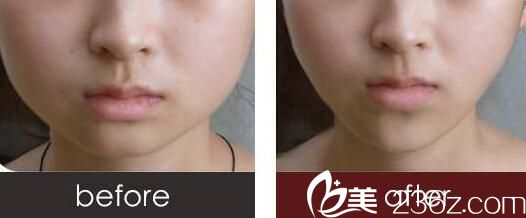 注射瘦臉真人前后對(duì)比效果