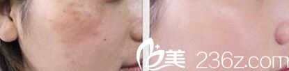 激光祛斑嫩膚真人前后對(duì)比