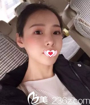 藍(lán)山整形醫(yī)生盧闖做鼻綜合術(shù)后18天完全消腫 藍(lán)山整形醫(yī)生盧闖做鼻綜合術(shù)后18天完全消腫