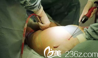 腹部吸脂手術(shù)進(jìn)行照片