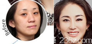 寒假臨沂伊維美整形活動(dòng)價(jià)格大促銷，雙眼皮只需1988內(nèi)切法去眼袋2800