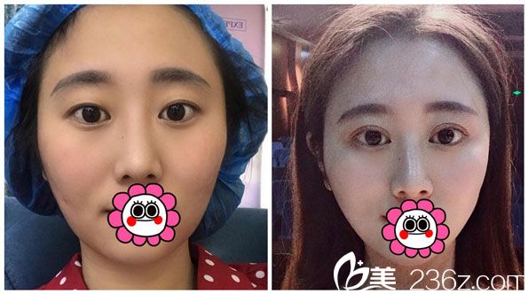 肖育亮眼綜合+全切雙眼皮效果對比圖 肖育亮眼綜合+全切雙眼皮效果對比圖