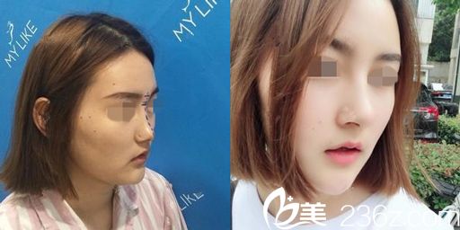 白玉龍主任做假體隆鼻術(shù)前術(shù)后對(duì)比圖