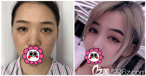 王德寧假體隆鼻+激光祛斑效果案例 王德寧假體隆鼻+激光祛斑效果案例