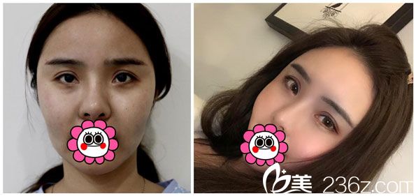 胡喬自體脂肪全臉填充效果對比圖 胡喬自體脂肪全臉填充效果對比圖