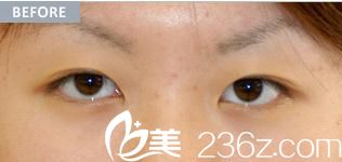 赤井醫(yī)院赤井秀實給我做切開雙眼皮前 赤井醫(yī)院赤井秀實給我做切開雙眼皮前