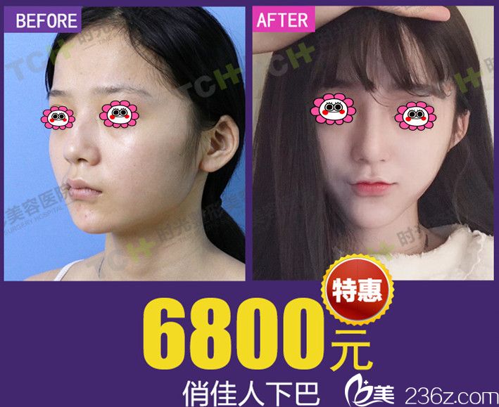 重慶時(shí)光墊下巴前后對(duì)比圖