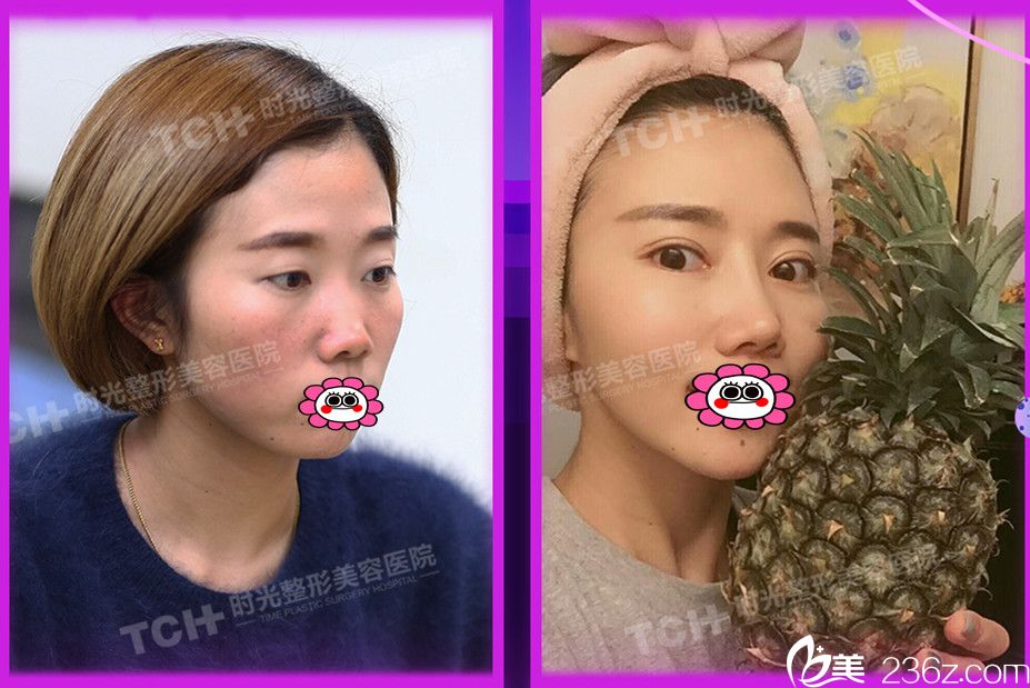 時(shí)光雙眼皮+隆鼻案例效果圖