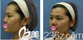 在北京雅靚做眼綜合前樣子 在北京雅靚做眼綜合前樣子