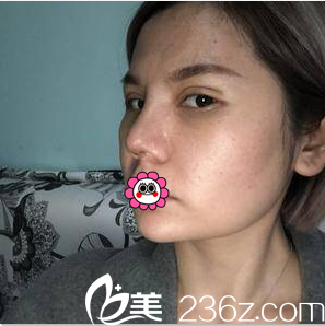 陳林葉給我做眼綜合第10天效果 陳林葉給我做眼綜合第10天效果