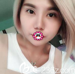 北京雅靚眼綜合案例 北京雅靚眼綜合案例