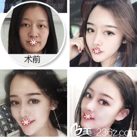 貴陽美萊整形隆鼻好不好？