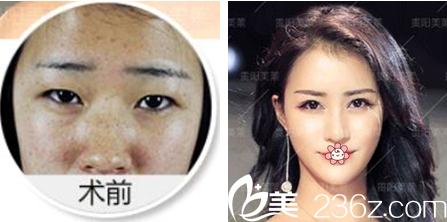 貴陽美萊祛斑案例