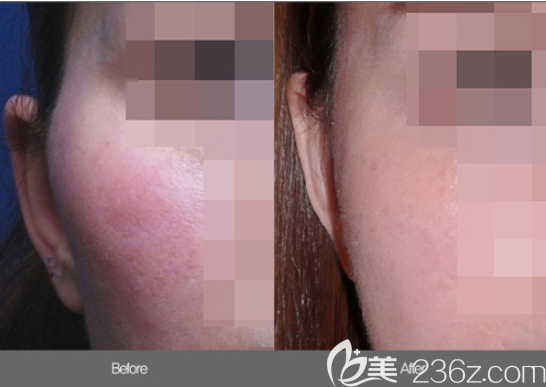 韓國(guó)洪承業(yè)整形外科顴骨整形案例對(duì)比圖 韓國(guó)洪承業(yè)整形外科顴骨整形案例對(duì)比圖