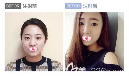 注射瑞藍(lán)2號(hào)玻尿酸填充下巴、鼻子、淚溝真人前后效果對(duì)比