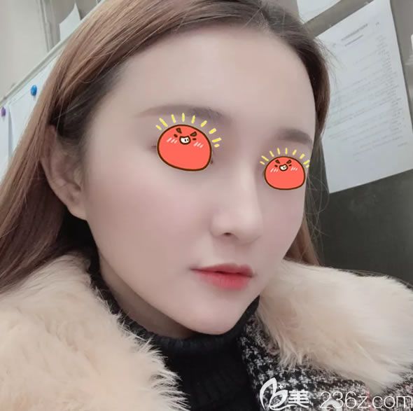 用改頭換面來形容我在義烏陽光美容醫(yī)院做自體脂肪填充的效果一點(diǎn)兒也不過分,不信看高清大圖