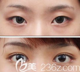 雙眼皮7mm一年后照片