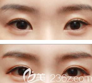 雙眼皮修復(fù)案例圖