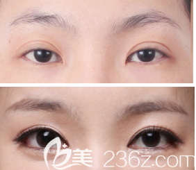 過(guò)寬雙眼皮改造案例