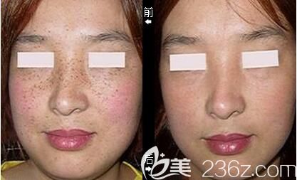 武強(qiáng)醫(yī)生做皮秒祛斑術(shù)前術(shù)后案例對(duì)比