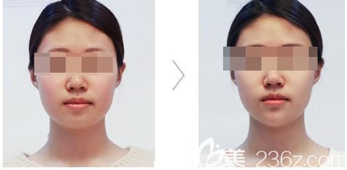 田雨注射瘦臉除皺案例