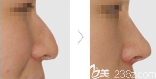 田雨鼻尖形成術(shù)案例