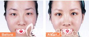 唐山紫水仙2019年整形優(yōu)惠活動(dòng)超劃算 1800元就能擁有自然款雙眼皮