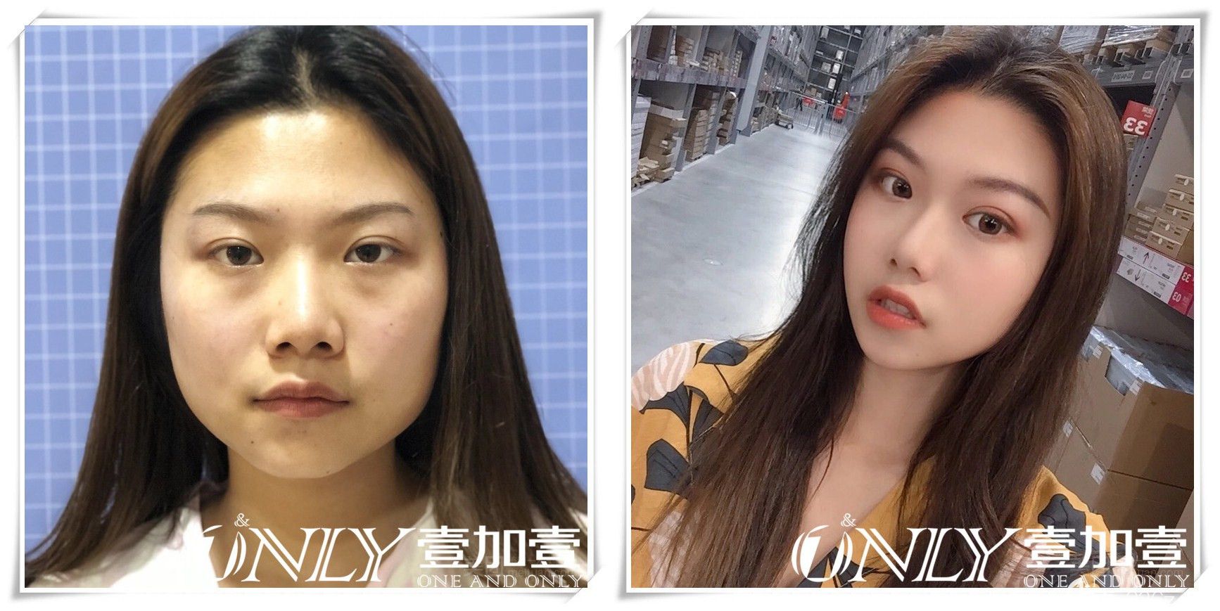 合肥壹加壹孟松怎么樣？面部吸脂真人案例來驗(yàn)證