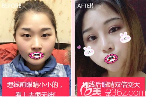 公布全新大韓整形醫(yī)院價(jià)格表，埋線雙眼皮低至980元附閆小宇雙眼皮案例